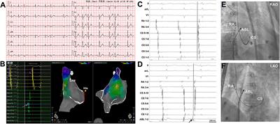 Mapping and Ablation of Isolated Frequent Symptomatic Premature Atrial Contractions in Patients With Structurally Normal Heart